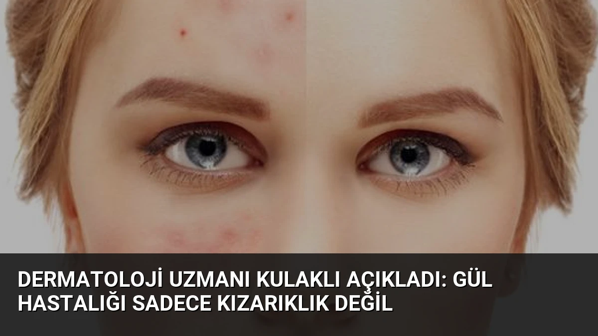 Dermatoloji Uzmanı Kulaklı Açıkladı: Gül Hastalığı Sadece Kızarıklık Değil