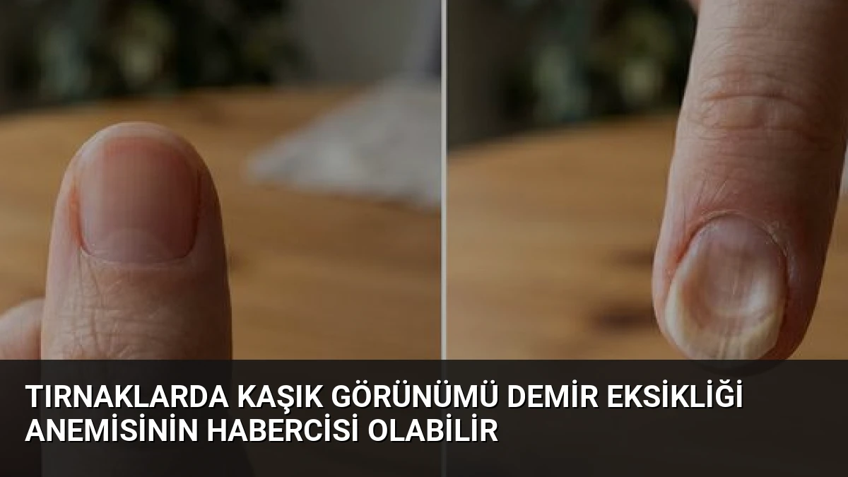 Tırnaklarda Kaşık Görünümü Demir Eksikliği Anemisinin Habercisi Olabilir